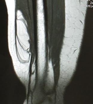 Lipoma MRI 1